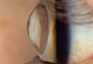 Keratoconus