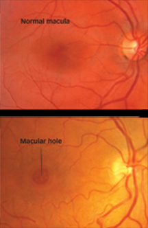 Macular Hole