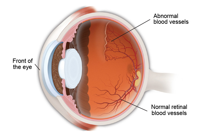 Retinopathy of prematurity (ROP) is an eye disease that occurs in a small percentage of premature babies. In ROP, abnormal blood vessels grow on the retina Retinopathy of prematurity (ROP) is an eye disease that occurs in a small percentage of premature babies. In ROP, abnormal blood vessels grow on the retina