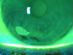 corneal abrasion
