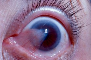 pterygium