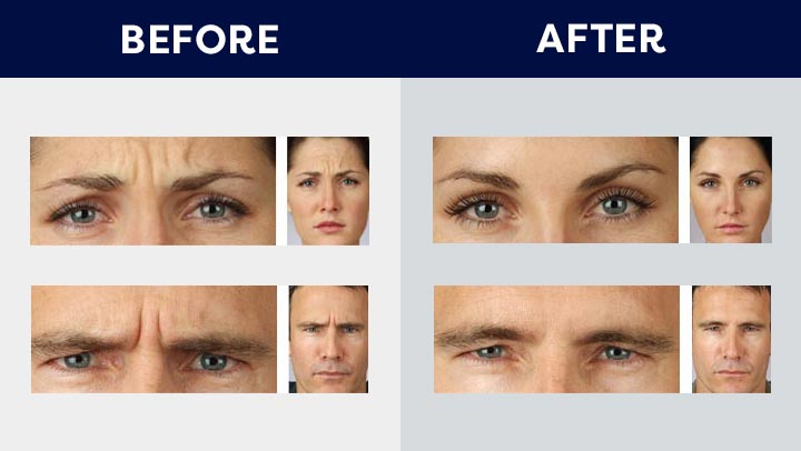 Allergan Botox 